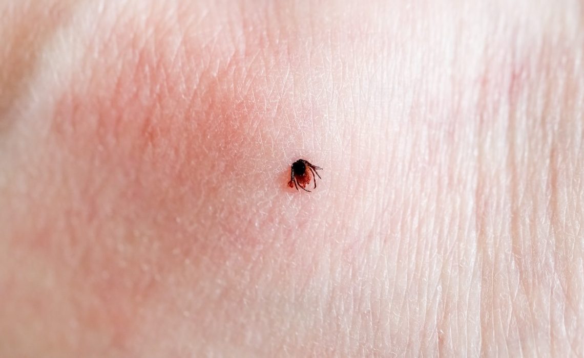 A One small tick embedded in the skin of a Caucasian man on the leg on a summer day, close-up view from above.tick embedded in a person skin.
