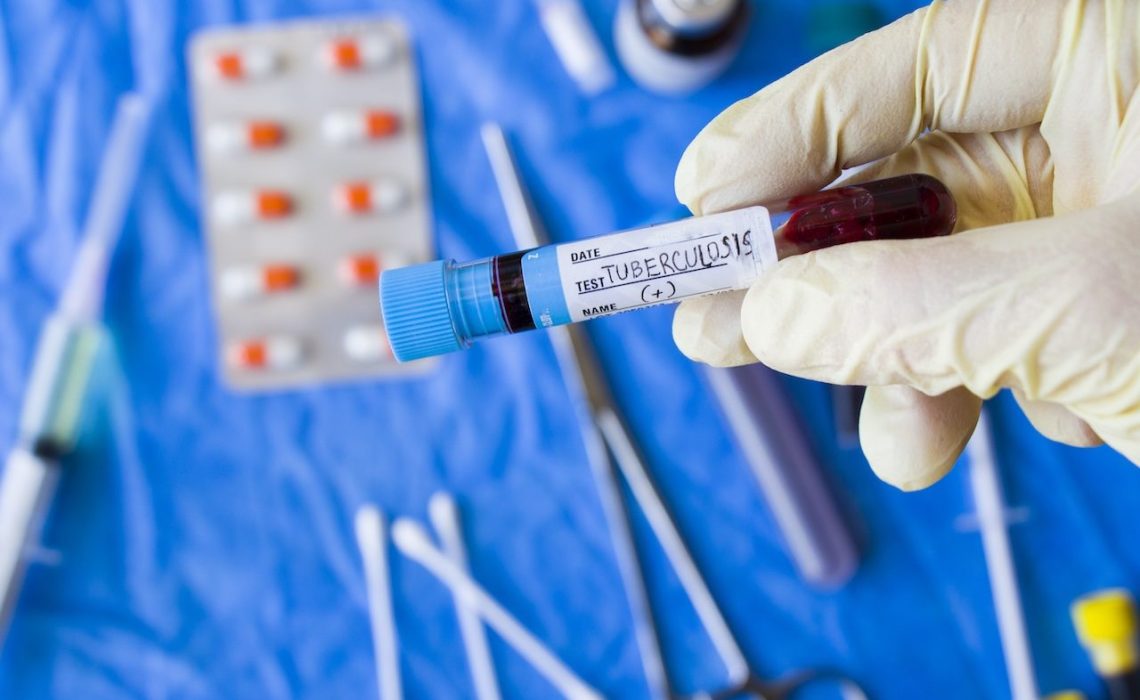 A doctor with a latex glove holding a positive tuberculosis blood test tube in the laboratory