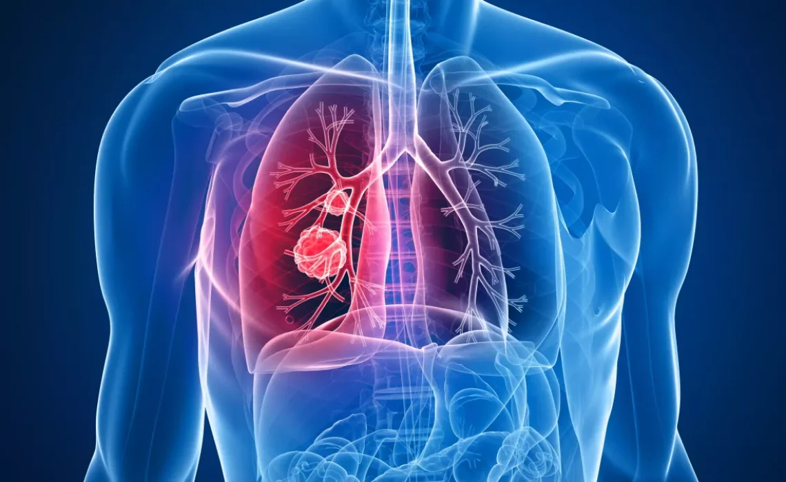 i104764-cancer-poumon-pm